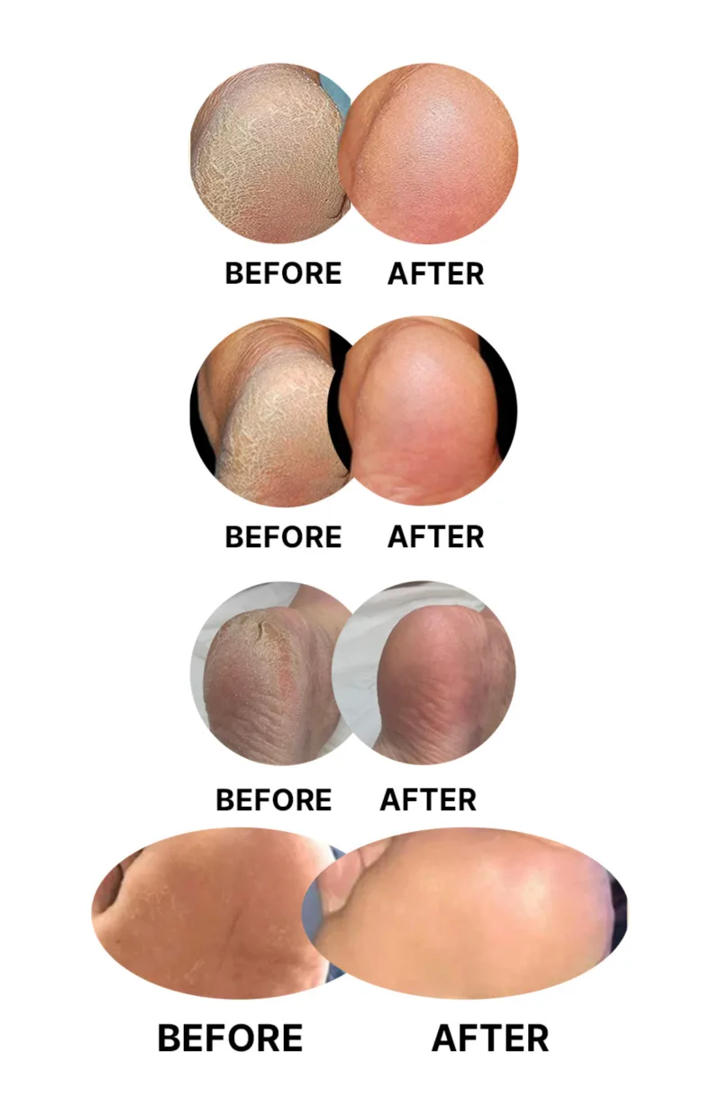 PediXpert Callus Remover