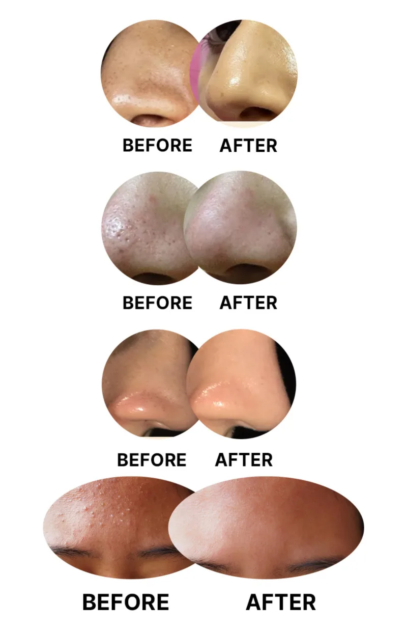 Clear Blackhead Remover