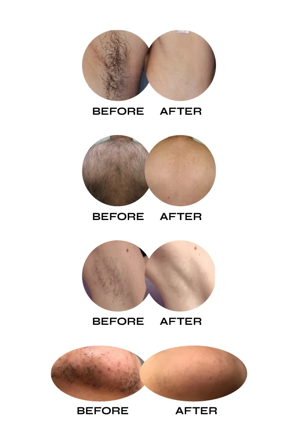 Flow IPL Laser Hair Removal Device